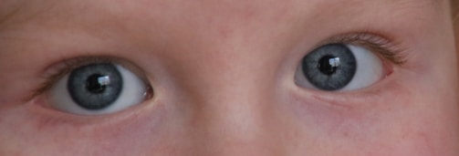 Close-up of a patient’s eyes after laser eye surgery, looking vibrant and clear.