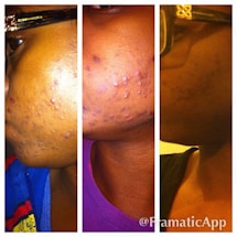 A three-panel collage showing a person's cheek with visible acne or skin issues, possibly improving over time. The images appear to be a progression of skin condition from left to right.