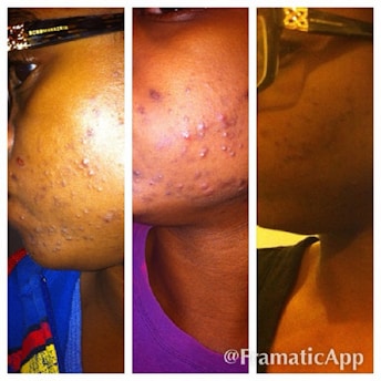 A three-panel collage showing a person's cheek with visible acne or skin issues, possibly improving over time. The images appear to be a progression of skin condition from left to right.