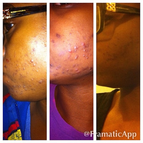 Before and after images showing skin improvement results.