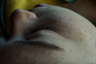 Close-up of a patient’s eyes before upper eyelid blepharoplasty, highlighting natural skin folds.