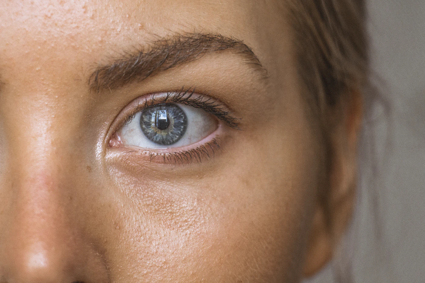 Close-up portrait of a person's eye and under-eye skin texture, representing periorbital assessment for pigmented dark circles