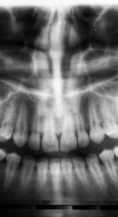 teeth X-ray