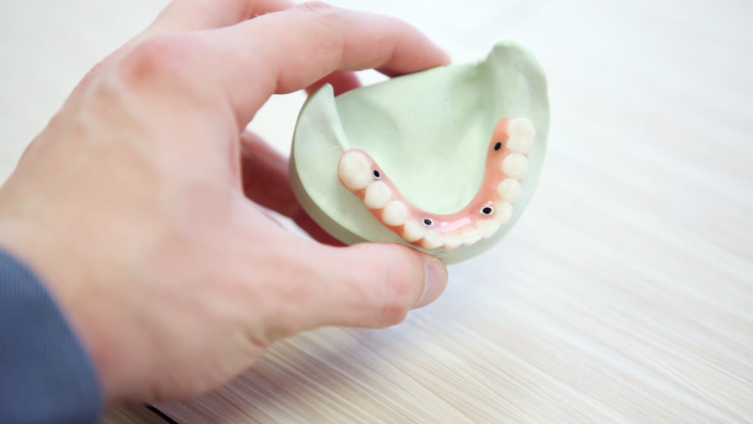 This is a snapshot of one of the most expensive dental treatments available in dentistry today. Four dental implants are used to secure a dental bridge of 12 teeth to restore the function and aesthetics of your teeth.