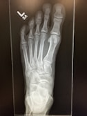An X-ray image of a human foot, showing the bones clearly. The skeletal structure includes the metatarsals, phalanges, and tarsal bones. The label 'L SA' is visible in the top left corner, indicating the left side.