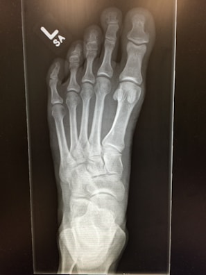 An X-ray image of a human foot, showing the bones clearly. The skeletal structure includes the metatarsals, phalanges, and tarsal bones. The label 'L SA' is visible in the top left corner, indicating the left side.