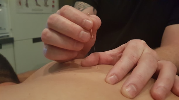 A person is performing acupuncture by gently inserting a thin needle into another person's skin. The focus is on the hands and needle, with a tattoo visible on the forearm. The setting appears to be a clinical environment with diagrams on the wall.