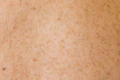 a close up of a person's back with brown spots