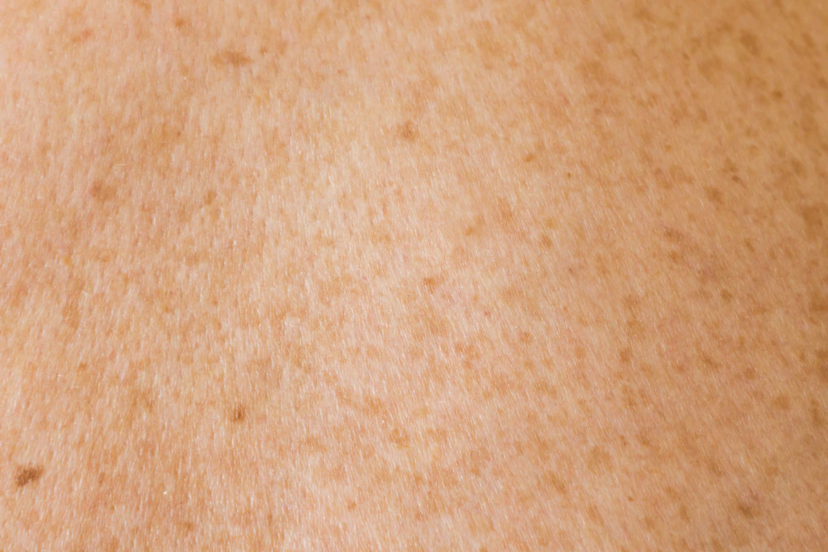 Close-up of sun-exposed skin on the upper back and shoulders showing scattered brown age spots from cumulative sun exposure