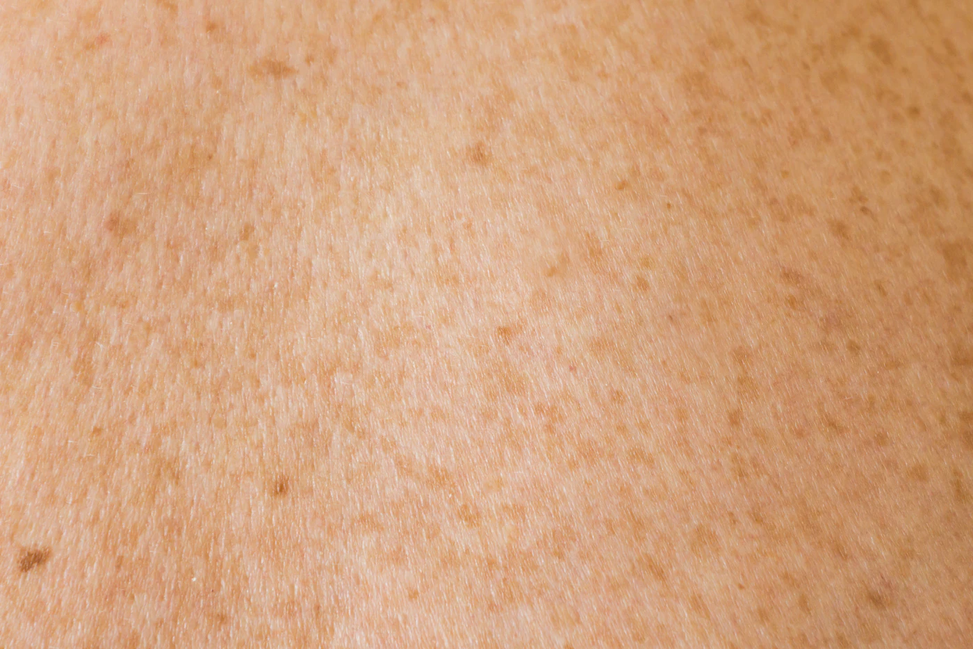 Marques post-imperfections : pourquoi elles mettent autant de temps à s'effacer