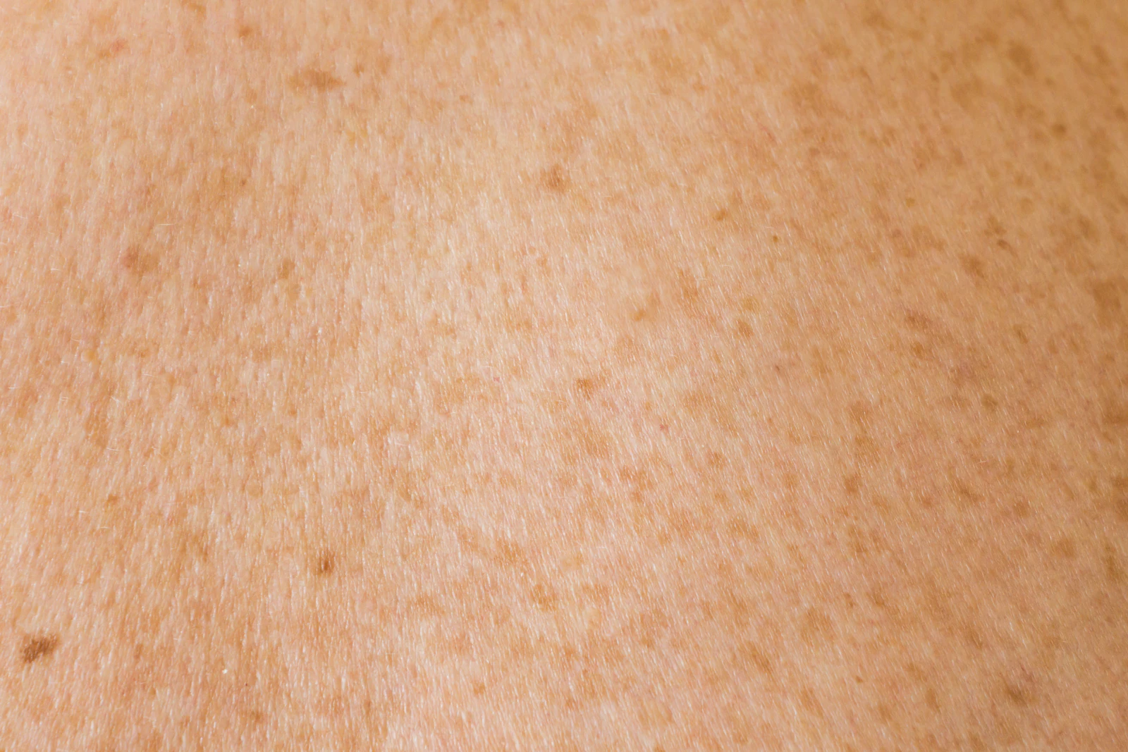 Close-up of skin texture with freckles and brown spots on a person's back