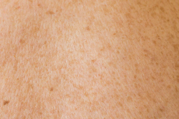 Peau et taches pigmentaires