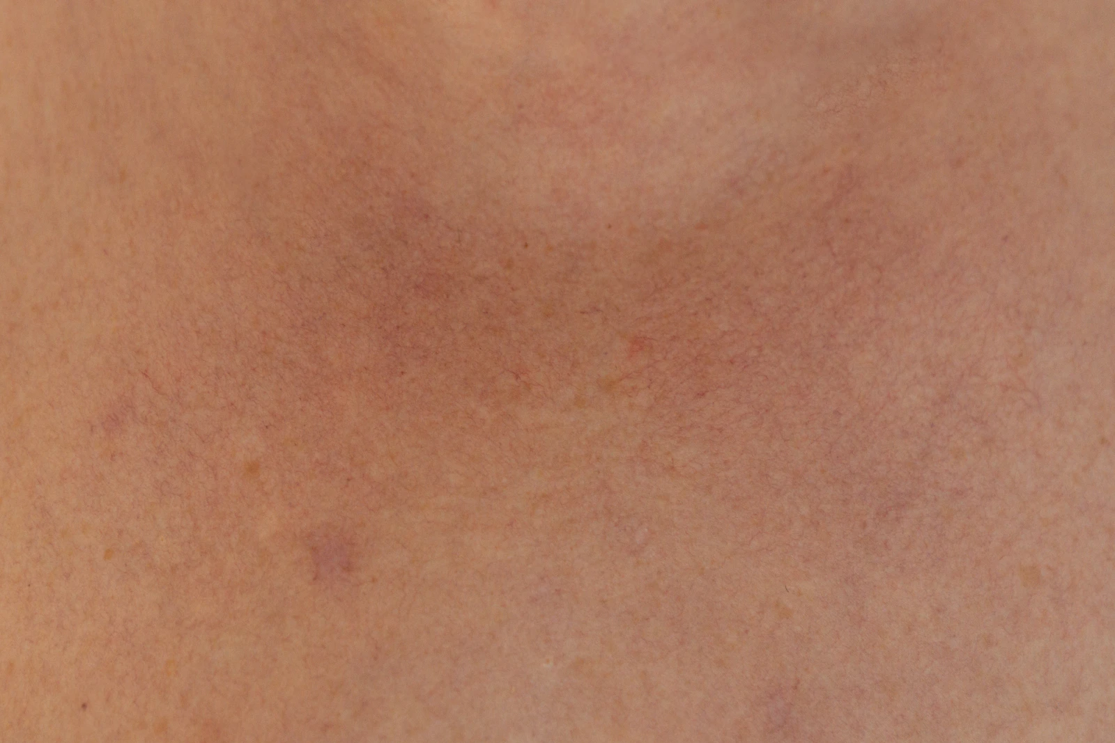 Close-up of a person's back showing redness and visible capillaries