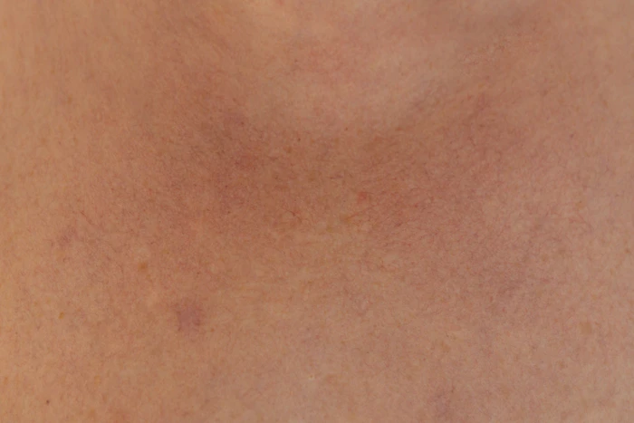 Close-up of skin on a person's back with faint redness and small marks (stand-in for acne marks)