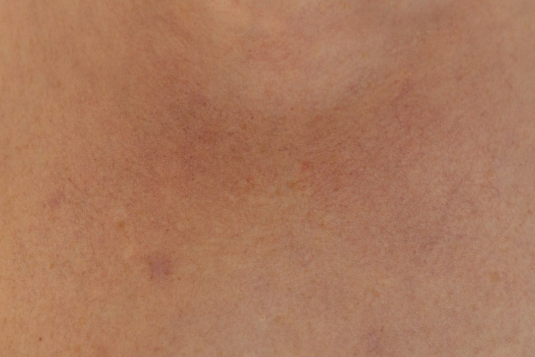 Peau avec des rougeurs diffuses et de petits vaisseaux visibles, signe d'une peau réactive