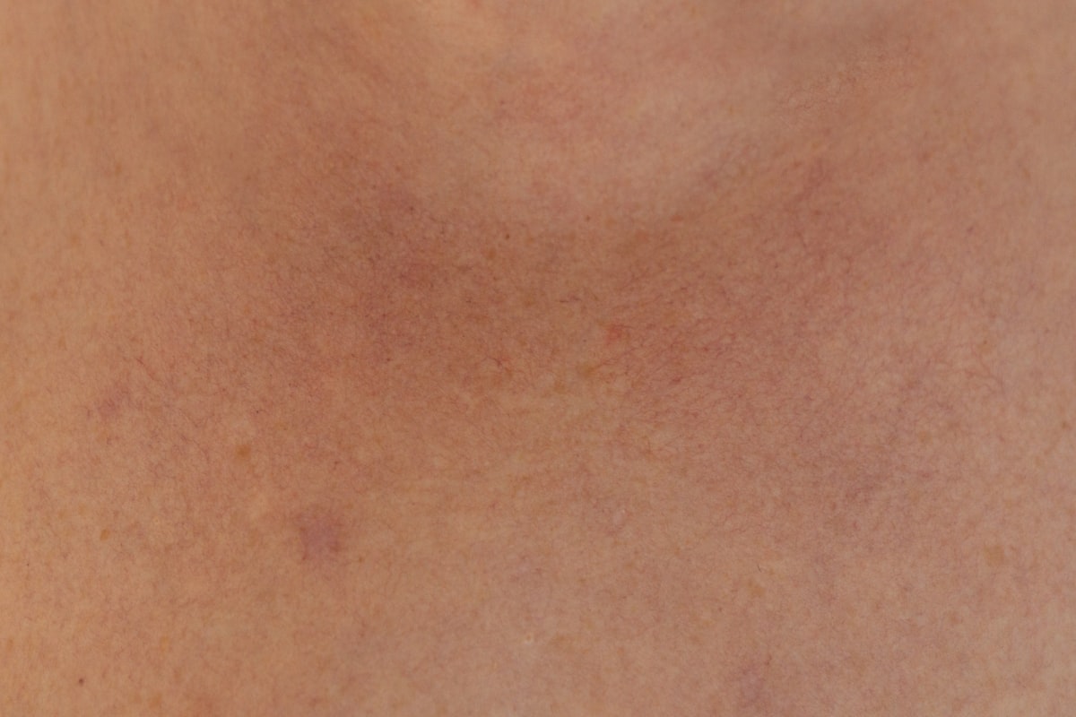 Melanoma