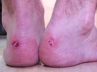 Both heels show visible blisters, with areas of red, broken skin and some surrounding inflammation.