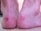 Both heels show visible blisters, with areas of red, broken skin and some surrounding inflammation.
