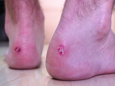 Two feet with noticeable blisters on the heels, possibly from friction or irritation. The skin around the blisters appears red and inflamed.