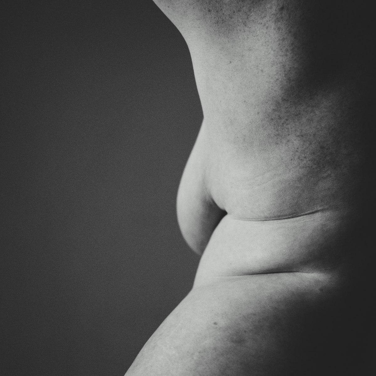 What Liposuction Can and Cannot Do