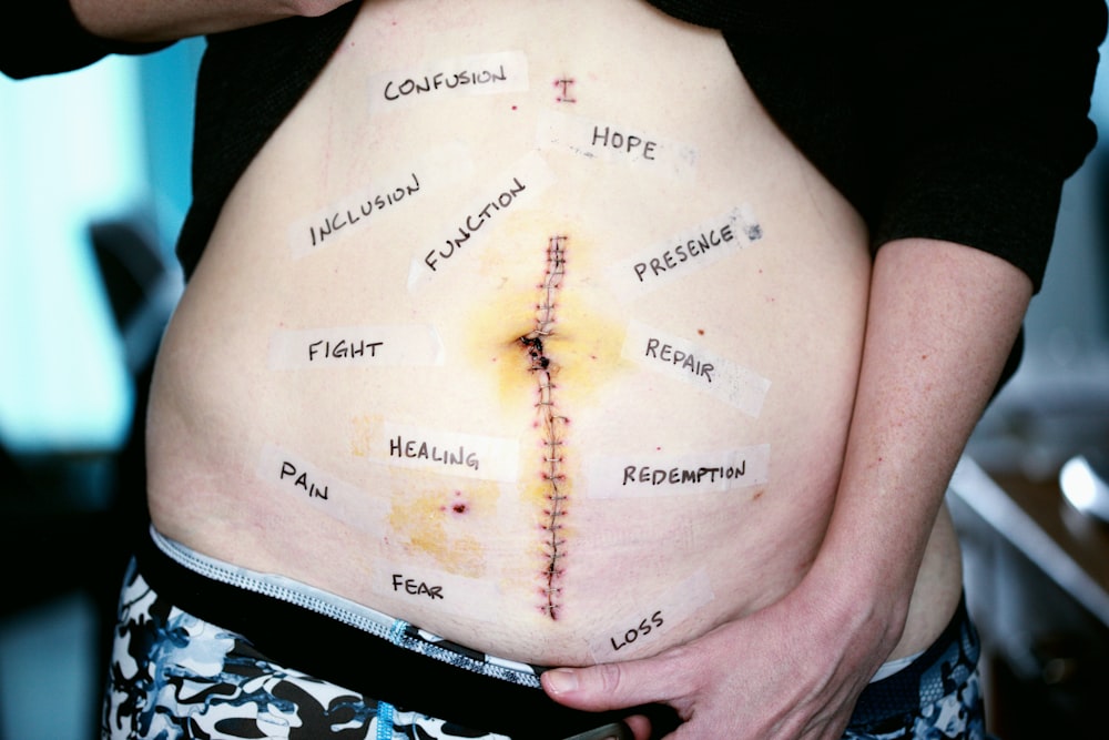 la barriga de la persona con puntos de sutura