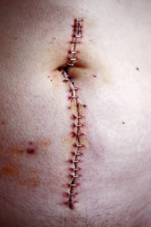 stitched stomach