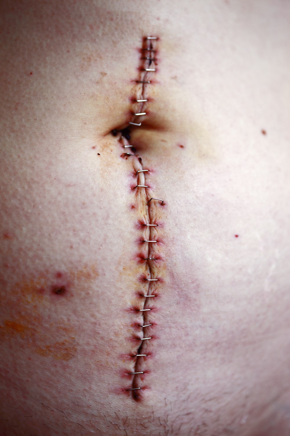 stitched stomach