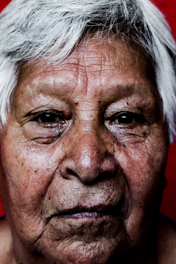 Portrait of a middle-aged woman with visible rosacea, highlighting skin redness in a calm clinical setting.
