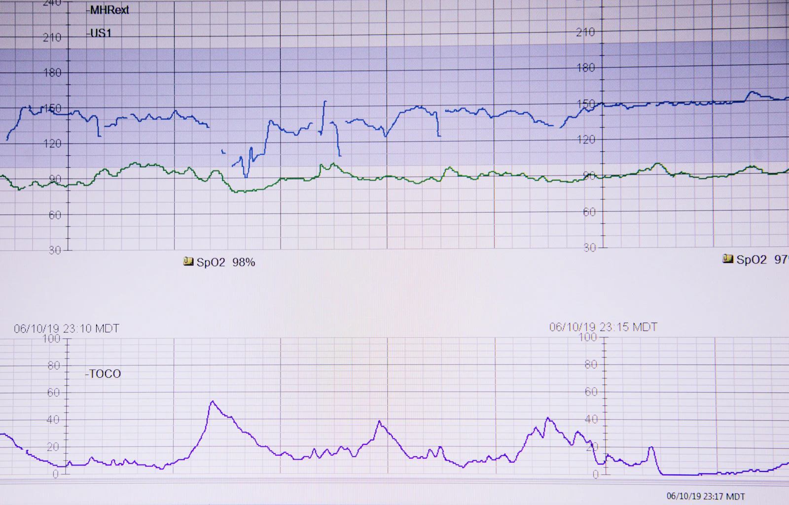 Cardiac rhythm tracing on clinical paper.