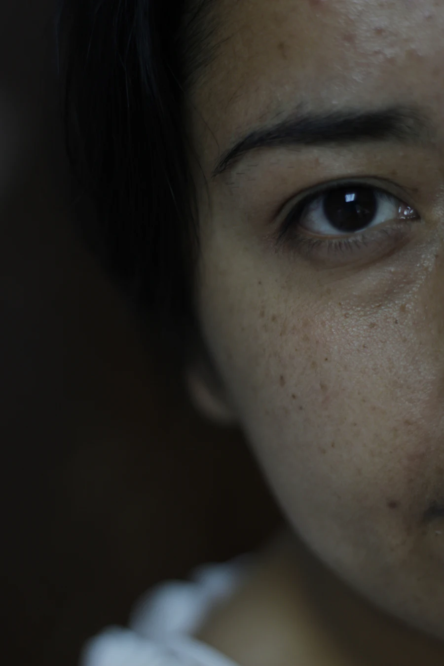Close crop of a face showing freckles and uneven pigment across the cheek