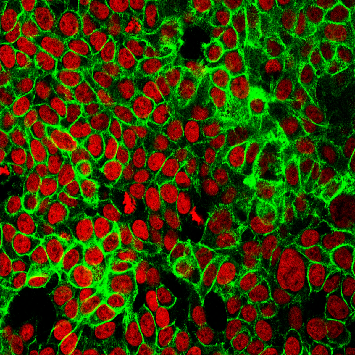 Cellule tumorali al microscopio &mdash; nuclei in rosso, proteina E-caderina in verde