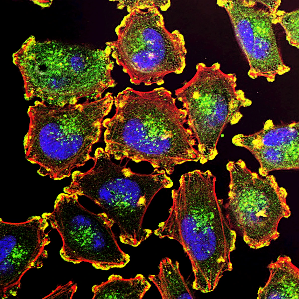 Cellule tumorali invasive al microscopio &mdash; filopodi che indicano migrazione attiva