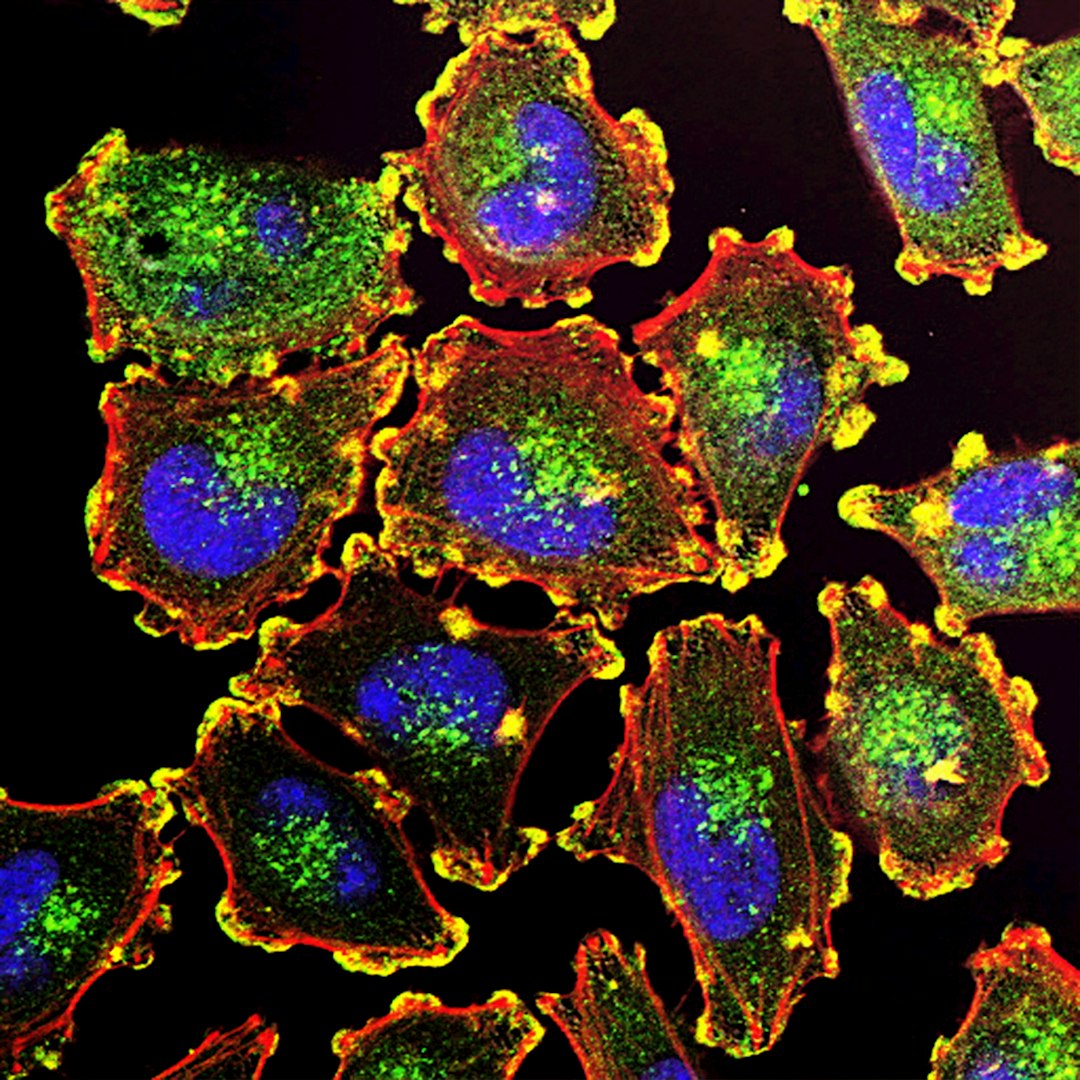 Metastatic Melanoma Cells. The ability of cancer cells to move and spread depends on actin-rich core structures such as the podosomes (yellow) shown here in melanoma cells. Cell nuclei (blue), actin (red), and an actin regulator (green) are also shown.
