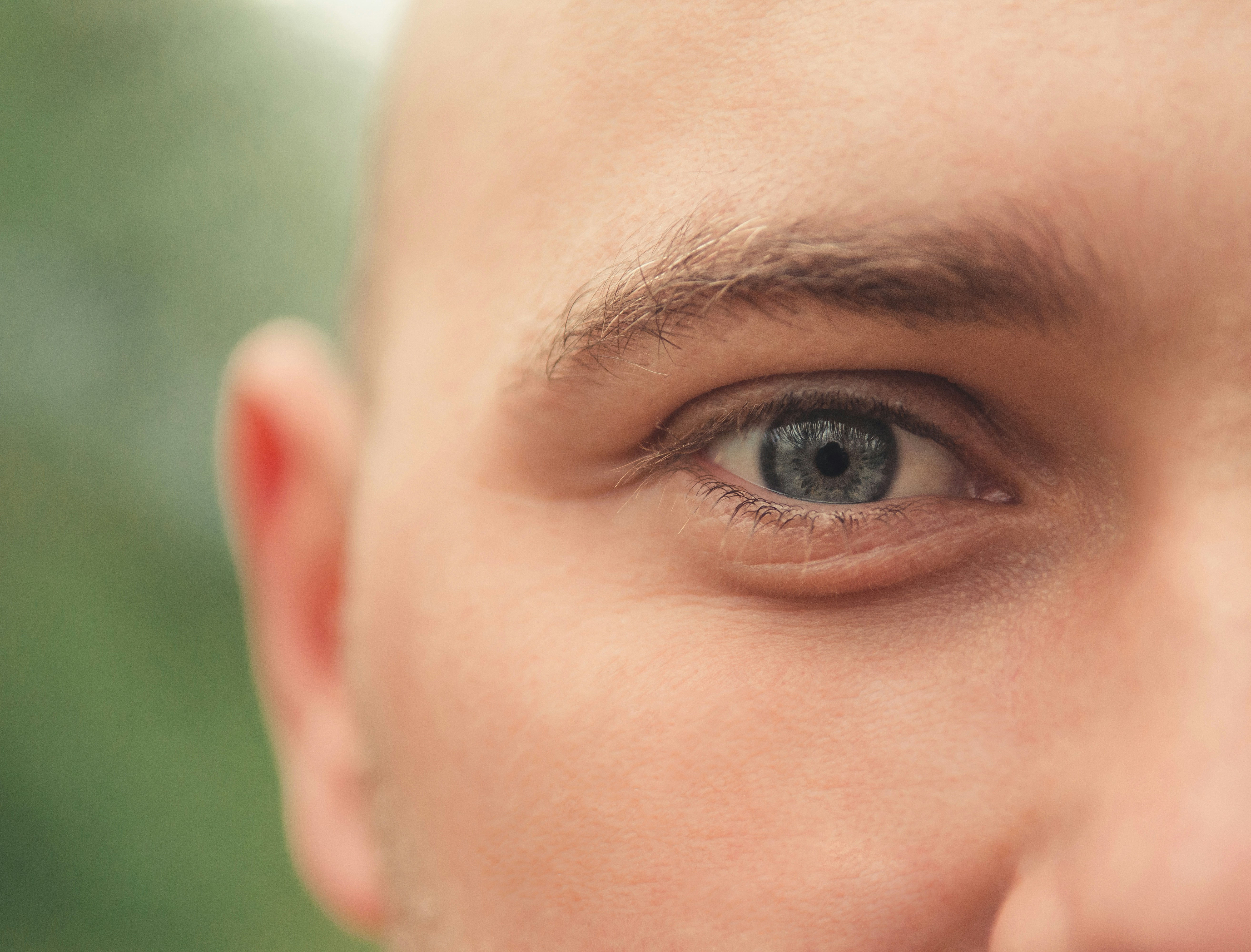 =acne whitehead pore close-up
, ilustrasi artikel Unmasking Whiteheads: Your Comprehensive Guide to Causes, Treatments, and Prevention 3