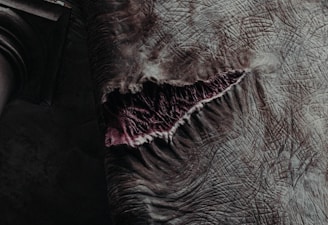 Close-up photo showing a patient's leg before filariasis surgery, highlighting swelling and skin changes.