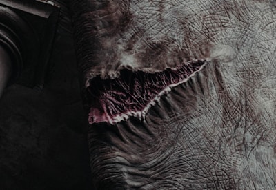 Close-up photo showing a patient's leg before filariasis surgery, highlighting swelling and skin changes.