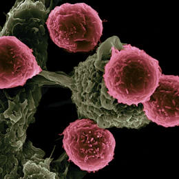 KRAS in pancreatic cancer: why it is so hard to target