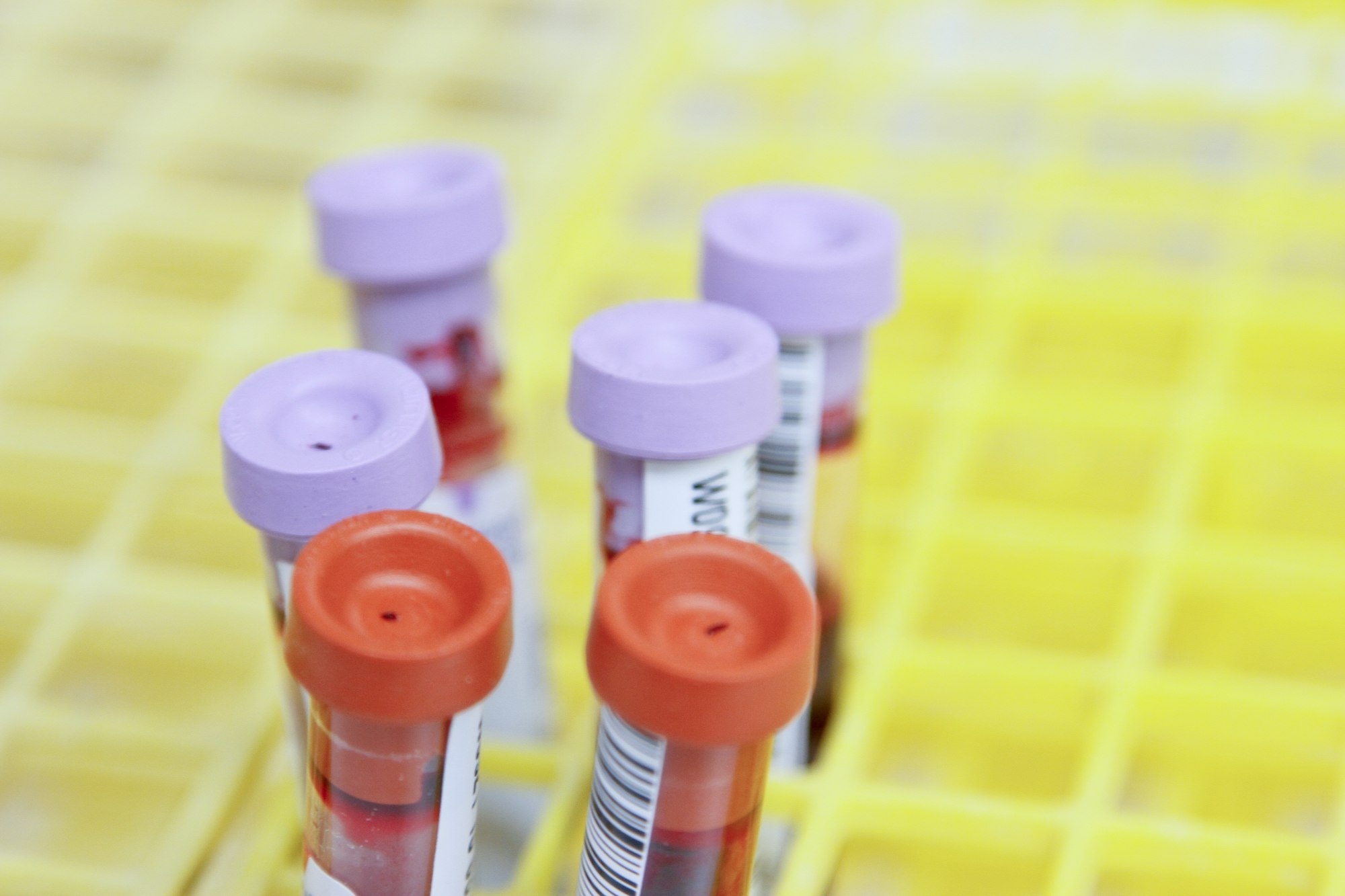 Novo exame de sangue pode detectar doença de Alzheimer