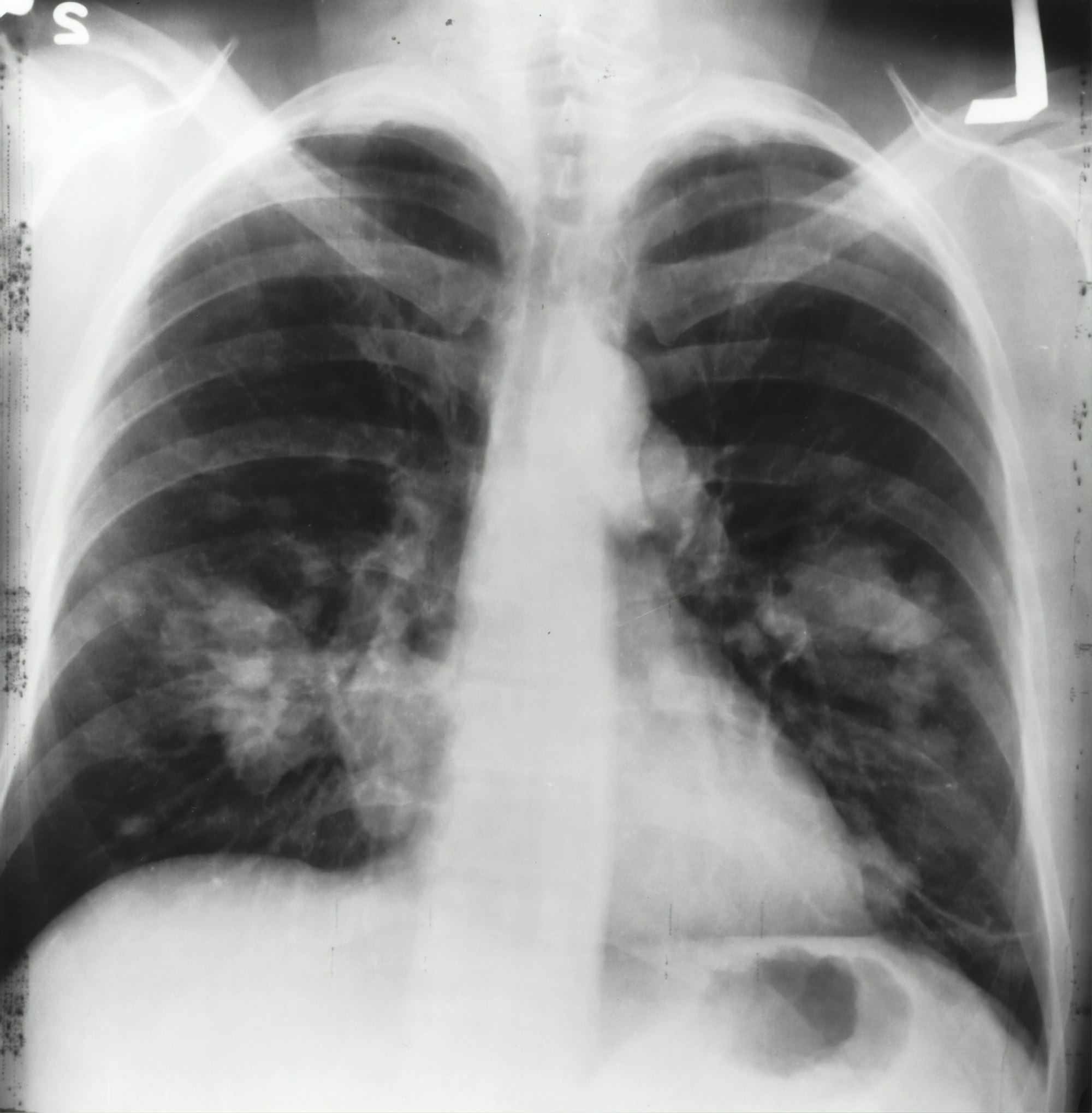 Ventilator Associated Pneumonia