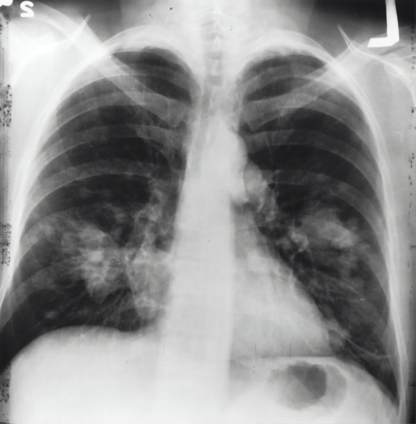 This is an x-ray image of a chest. Both sides of the lungs are visible with a growth on the left side of the lung, which could possibly be lung cancer.by National Cancer Institute