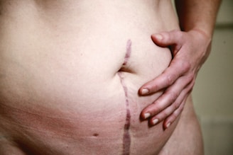 topless woman with skin condition