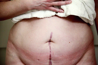 Patient walking confidently post-arthroscopy with visible minimal scarring.