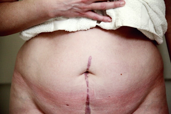 A close-up view of a person's abdomen with a prominent vertical scar. The skin appears slightly red and there is a towel partially covering the upper area while a hand rests on it.
