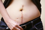 A close-up of a person's midriff with a vertical surgical scar held together by staples. The person's hand is slightly pulling down the waistband of jeans to reveal the lower part of the scar.