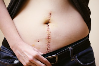 A close-up of a person's midriff with a vertical surgical scar held together by staples. The person's hand is slightly pulling down the waistband of jeans to reveal the lower part of the scar.