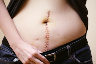 A close-up of a person's midriff with a vertical surgical scar held together by staples. The person's hand is slightly pulling down the waistband of jeans to reveal the lower part of the scar.