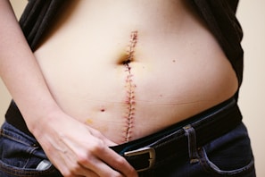 A close-up of a person's midriff with a vertical surgical scar held together by staples. The person's hand is slightly pulling down the waistband of jeans to reveal the lower part of the scar.
