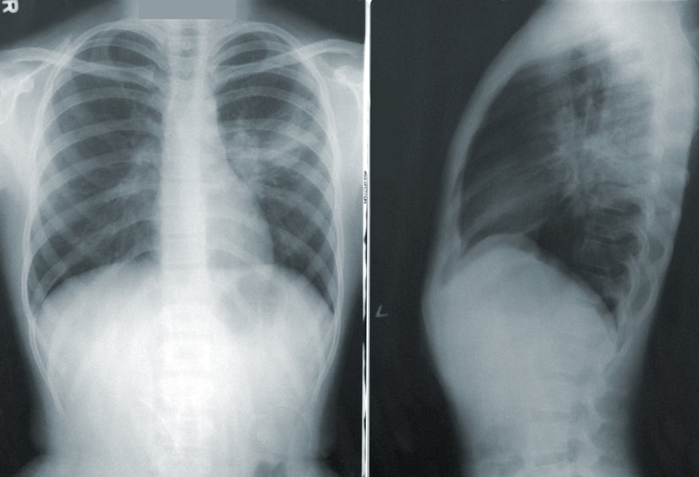 What does a chest X-ray show about your heart?