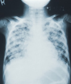 An X-ray image showing the upper torso, focusing on the ribcage, spine, and lungs. The bones appear in varying shades of white and gray against a black background.
