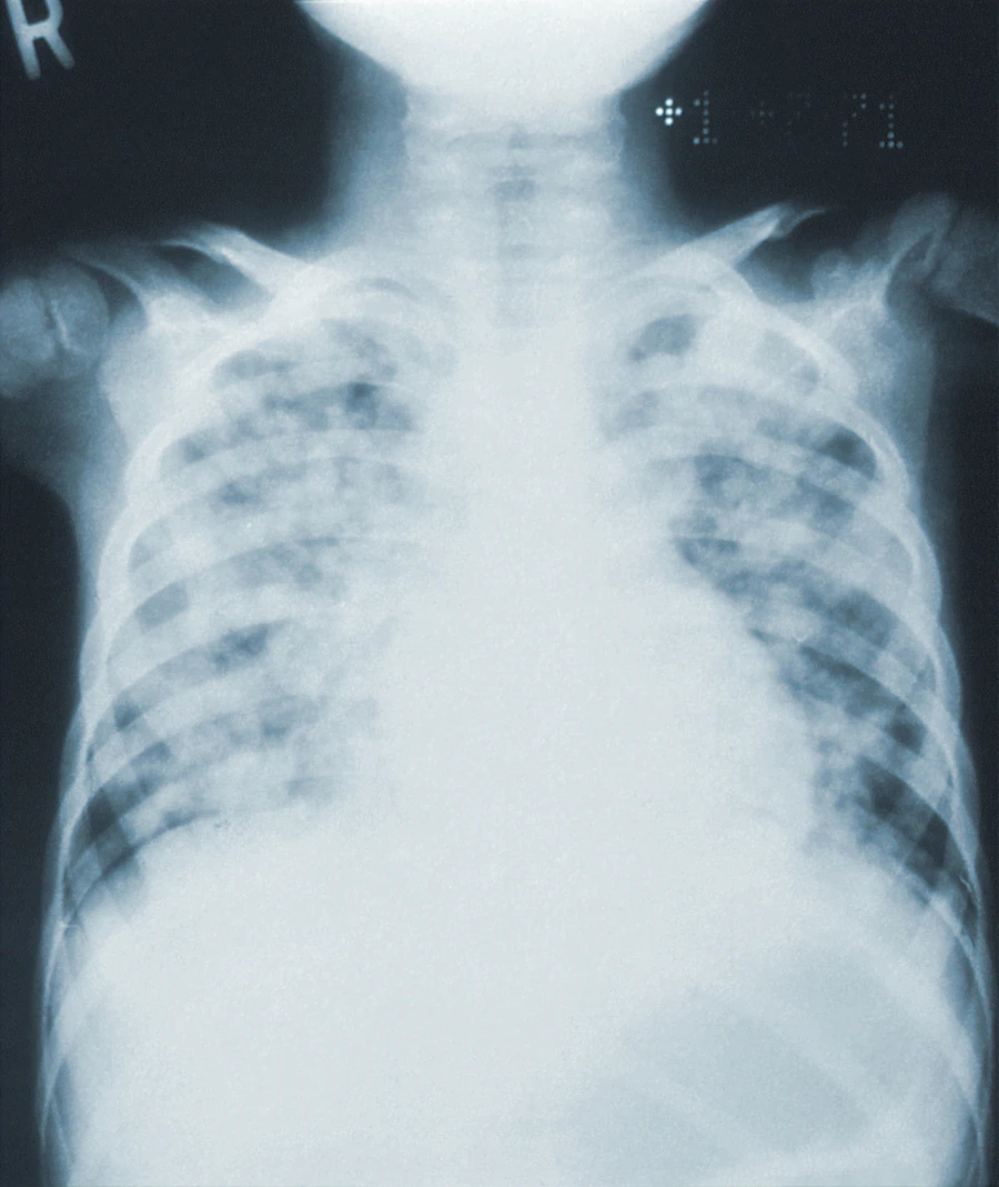 Radiografía de tórax pediátrica — imagen clínica de referencia relacionada con el diagnóstico cardiológico, sin mostrar personas